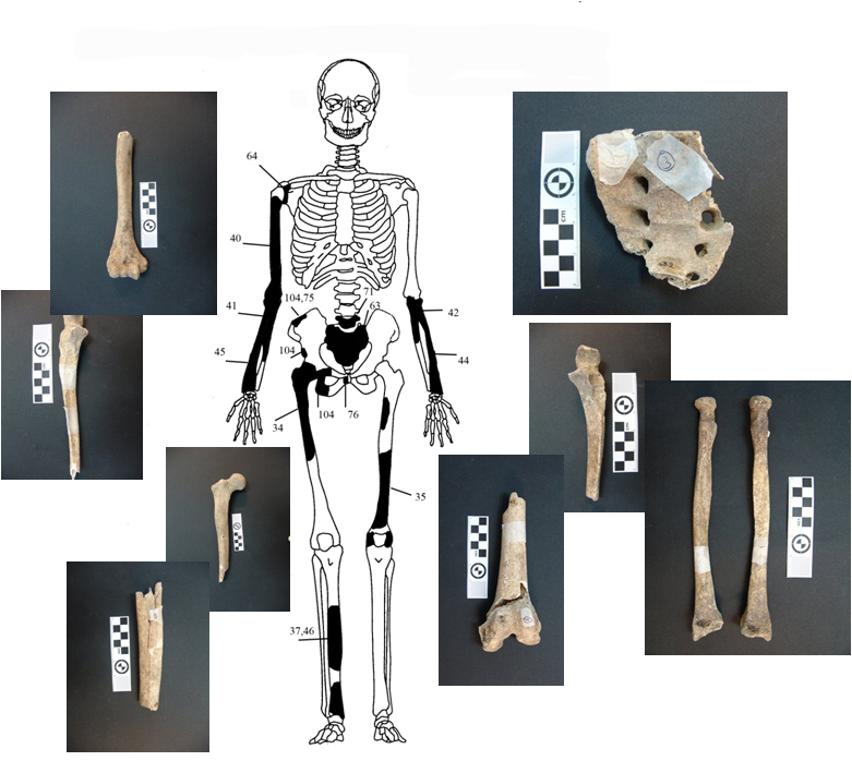 Εικόνα 6: Ενδεικτική εκπροσώπηση οστών Ατόμου 3 με φωτογραφίες οστών