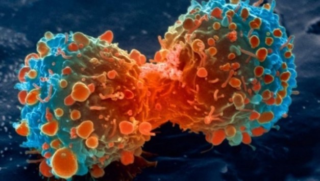 Επιτυχία: Έλληνας επιστήμονες εφηύρε μικροσκοπικές «χειροβομβίδες» κατά του καρκίνου