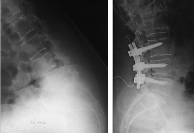 Άνδρας 45 ετών με σημαντικού βαθμού σπονδυλολίσθηση και σπονδυλική στένωση πριν και μετά το χειρουργείο