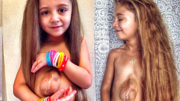 Απίστευτο: 7χρονη γεννήθηκε με την καρδιά ΕΞΩ από το στέρνο της – Δείτε πώς ζει! [vid, pics]