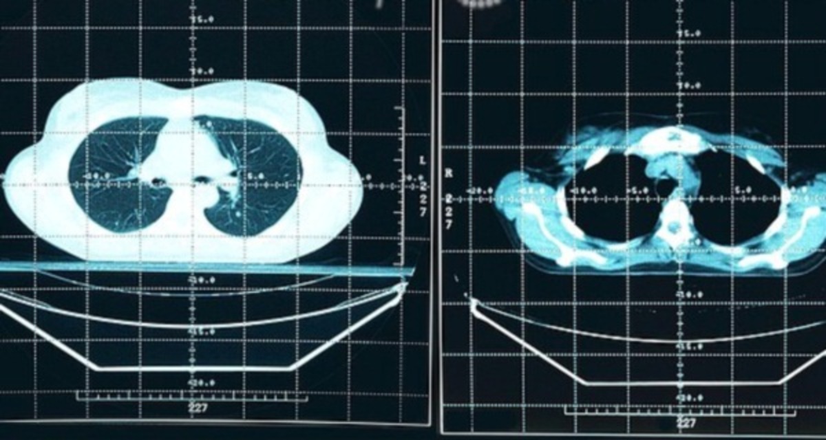 SOS γιατρών για τον καρκίνο του ήπατος | Newsit.gr SOS γιατρών για τον καρκίνο του ήπατος | Newsit.gr