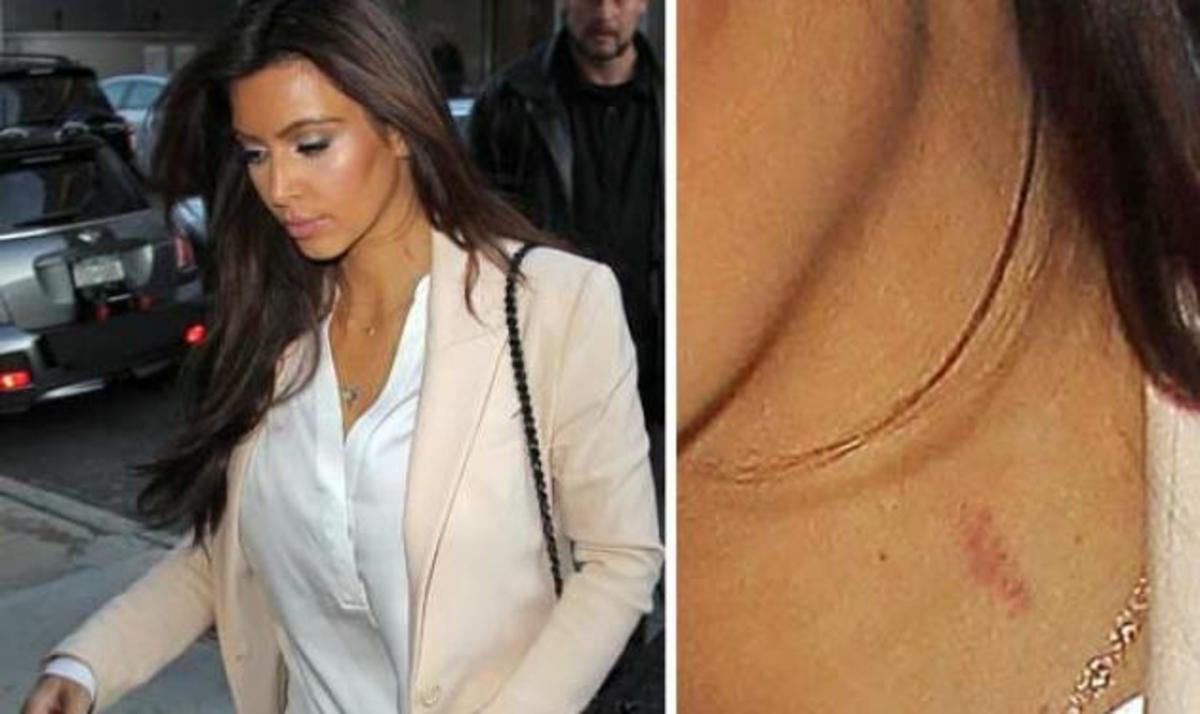 Το σημάδι στο λαιμό της Kim Kardashian και η νέα της σχέση! | Newsit.gr Το σημάδι στο λαιμό της Kim Kardashian και η νέα της σχέση! | Newsit.gr