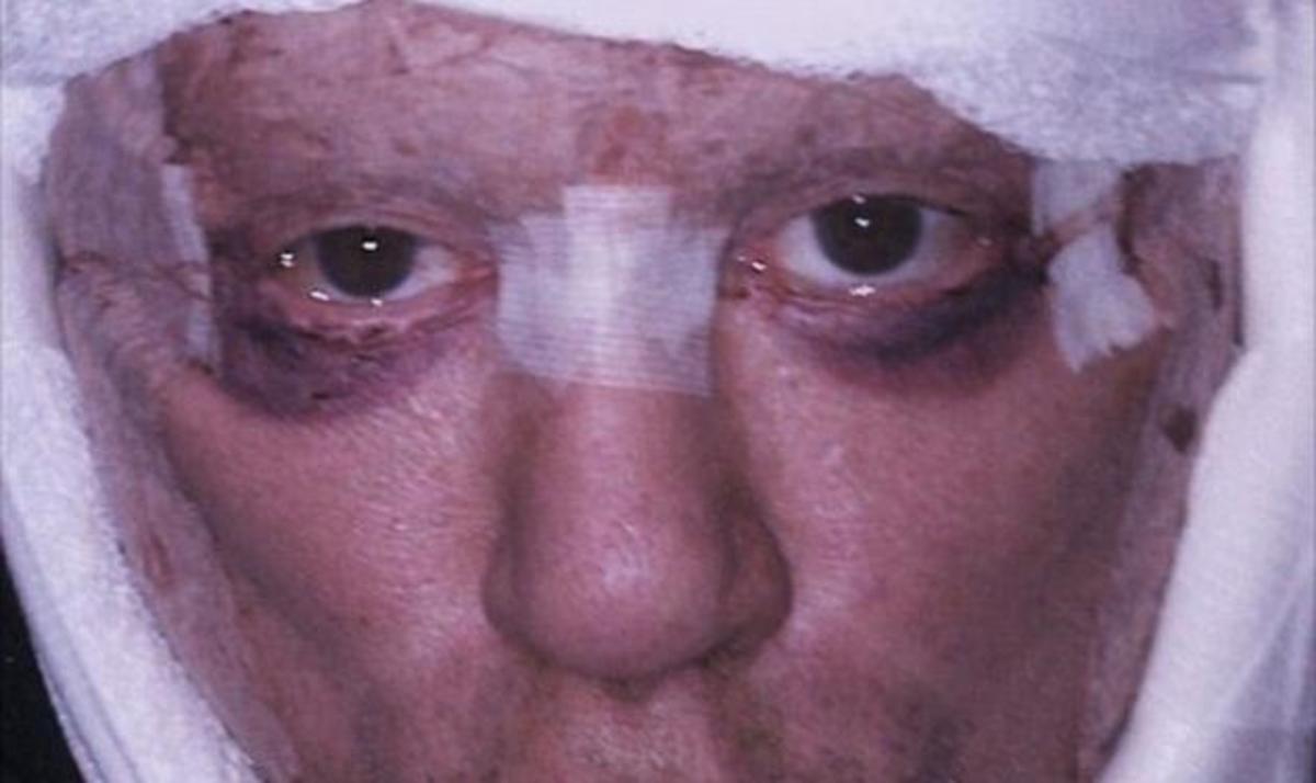 Σοκάρουν οι φωτογραφίες από την τελευταία πλαστική επέμβαση του Mickey Rourke! | Newsit.gr Σοκάρουν οι φωτογραφίες από την τελευταία πλαστική επέμβαση του Mickey Rourke! | Newsit.gr
