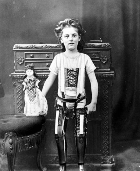 Ένα παιδί με προσθετικά πόδια το 1898
