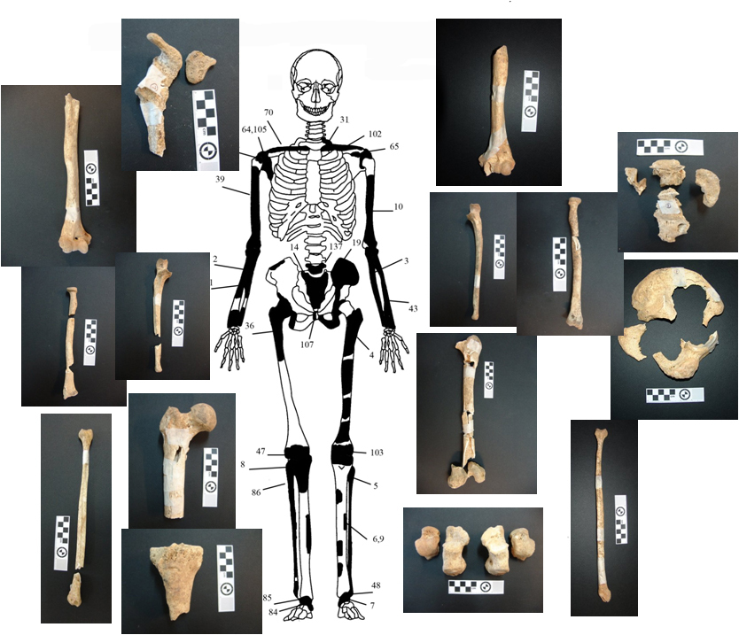 Εικόνα 4: Ενδεικτική εκπροσώπηση οστών Ατόμου 2 με φωτογραφίες οστών