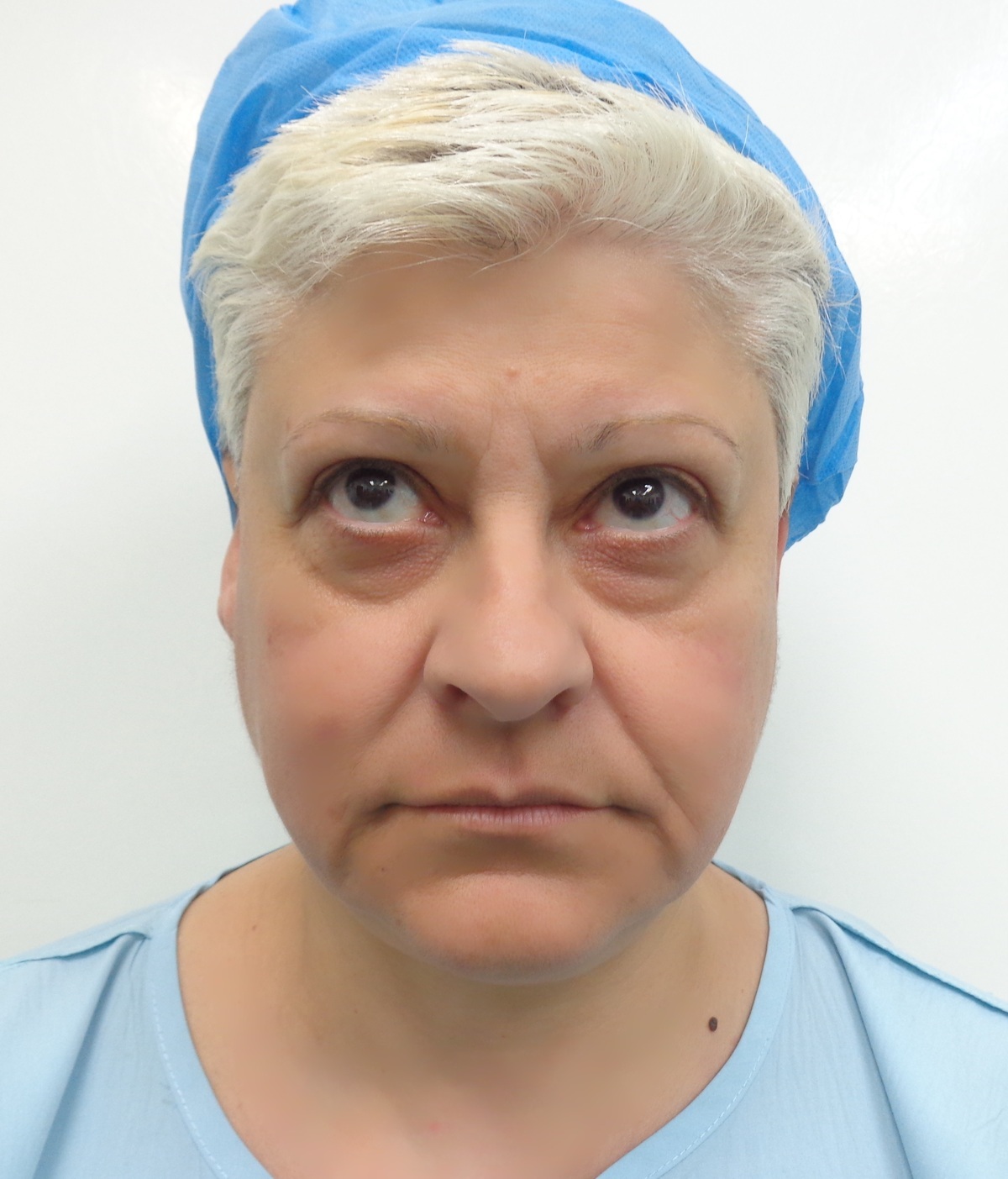 Η ασθενής που υποβλήθηκε σε Facelift, Ρινοπλαστική και Βλεφαροπλαστική, στην προηγούμενη ημερίδα Live Face Makeover 2