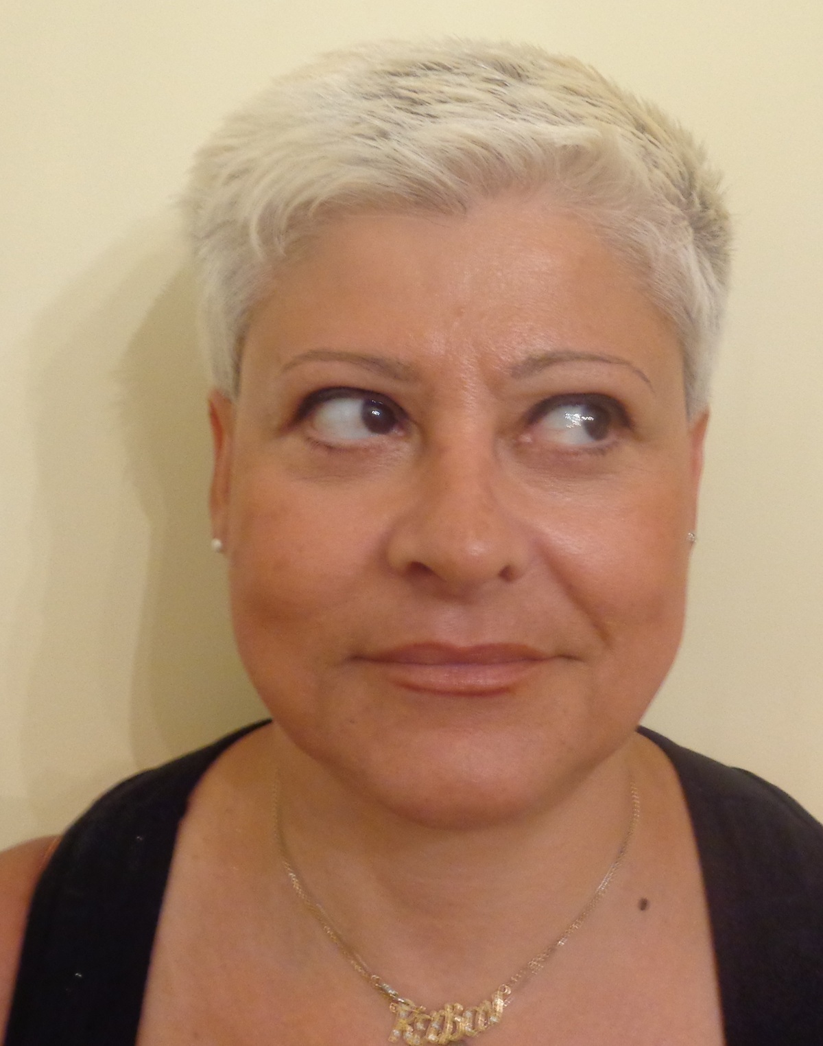 Η ασθενής που υποβλήθηκε σε Facelift, Ρινοπλαστική και Βλεφαροπλαστική, στην προηγούμενη ημερίδα Live Face Makeover 2
