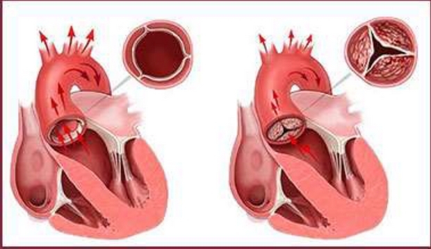 Εικόνα 1: σχηματική απεικόνιση μιας φυσιολογικής αορτικής βαλβίδας (αριστερά) και μιας ασβεστωμένης με σαφή περιορισμό στη διάνοιξη της και μείωση του εξωθούμενου όγκου αίματος από την καρδιά προς τη συστηματική κυκλοφορία (δεξιά).