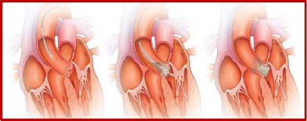 Εικόνα 4: Medtronic CoreValve, τρόπος ελεγχόμενης απελευθέρωσης.