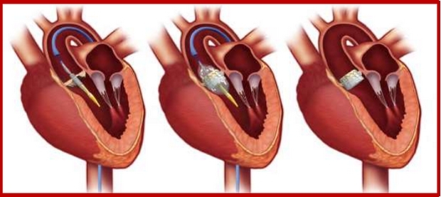 Εικόνα 5: Edwards SAPIEN Valve, τρόπος απελευθέρωσης με τη διαστολή μπαλονιού.