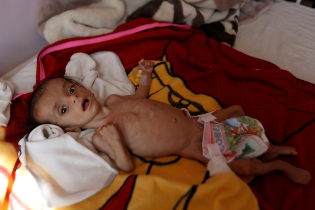 Κέντρο υποσιτισμού στην Υεμένη