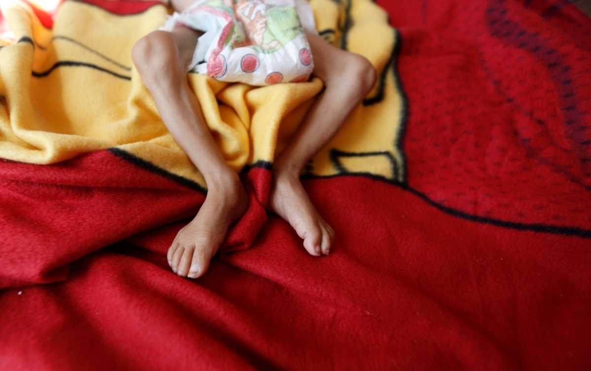 Κέντρο υποσιτισμού στην Υεμένη