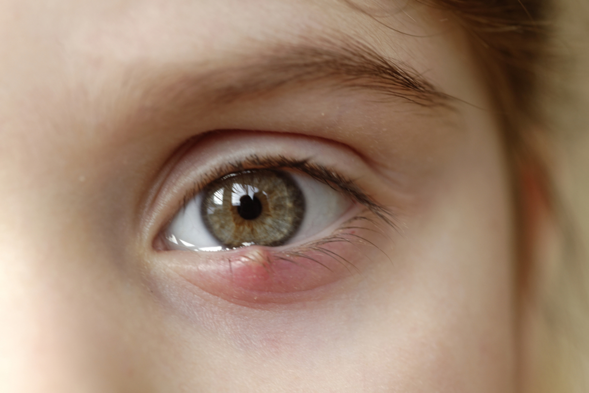 Τι να κάνετε για το κριθαράκι στο μάτι – Θεραπείες και πρόληψη