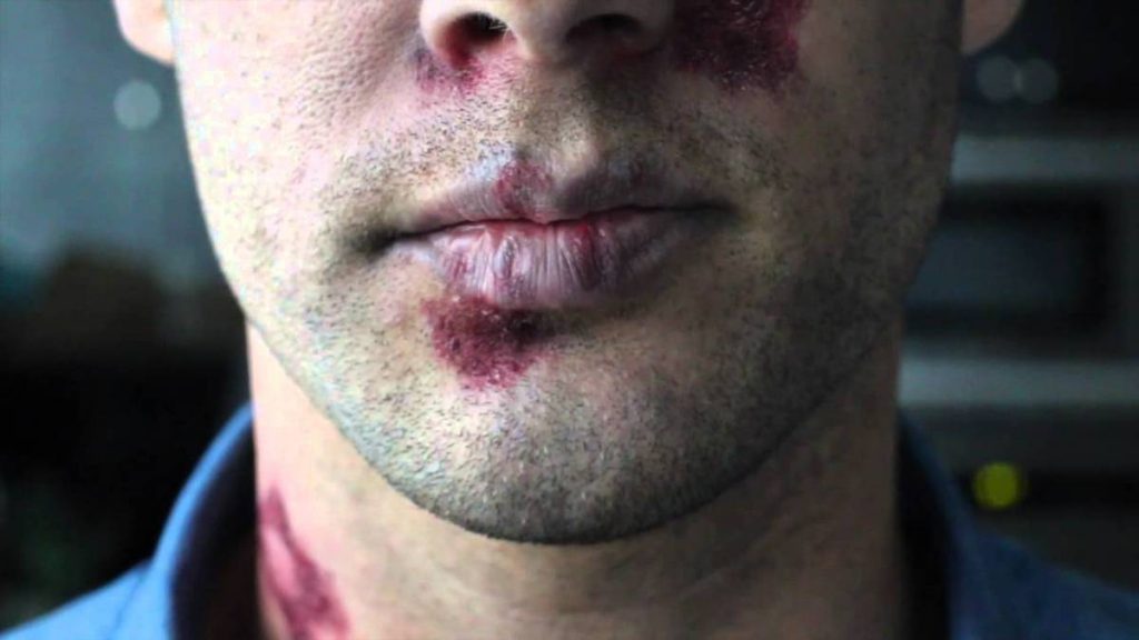 AIDS / HIV: Τα συμπτώματα που επιβάλλεται να γνωρίζουμε όλοι!