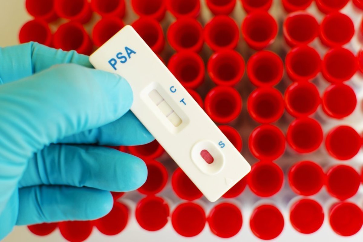 Προστατικό αντιγόνο: Τι πρέπει να γνωρίζει κάθε άντρας για τον έλεγχο του προστάτη