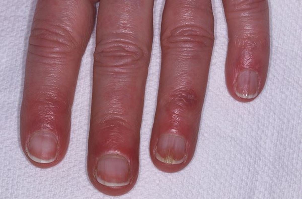 Χιονίστρες: Αίτια, συμπτώματα και θεραπεία για την δερματική φλεγμονή από το κρύο