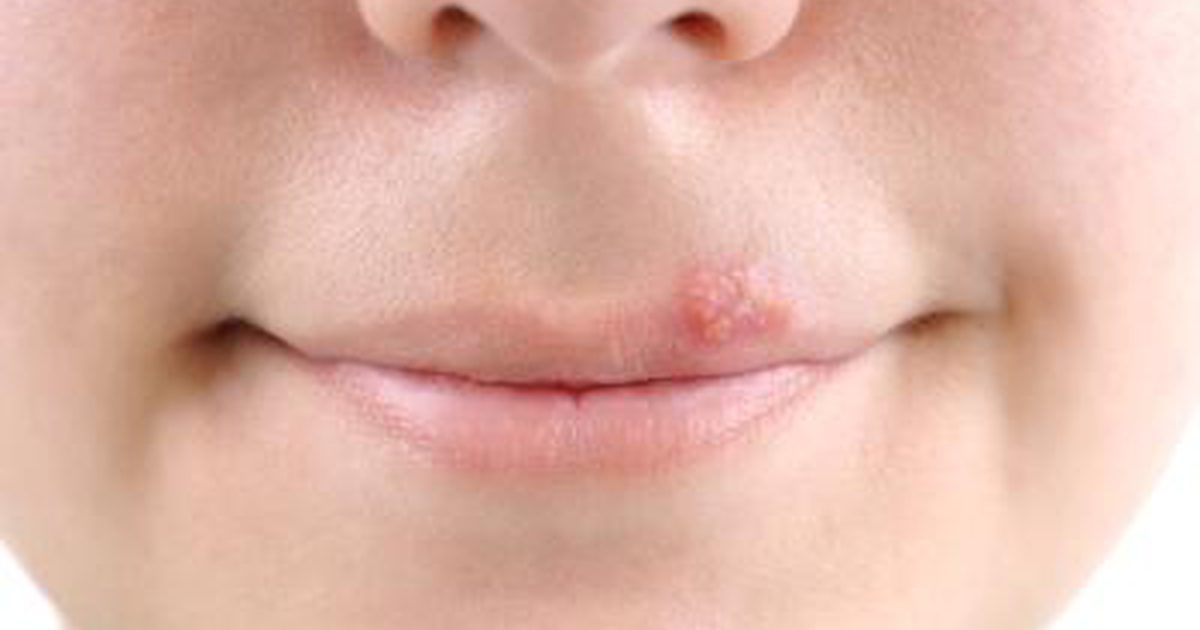 Επιχείλιος έρπης: Αίτια, συμπτώματα, αντιμετώπιση και πρόληψη