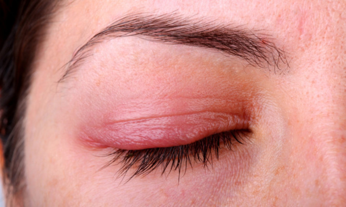 Βλεφαρίτιδα: Αίτια, συμπτώματα και τρόποι αντιμετώπισης