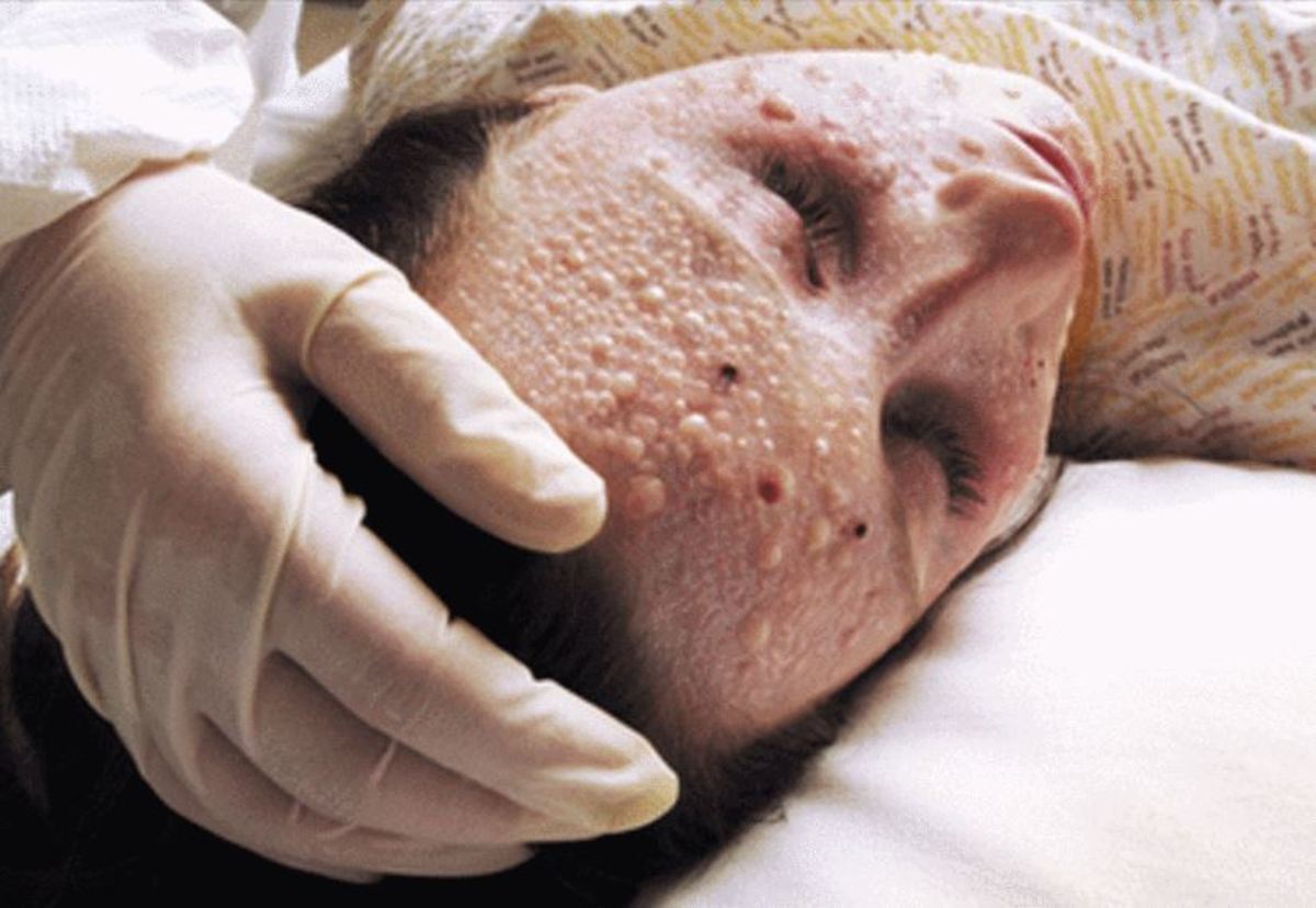 Ευλογιά: Τι πιστεύαμε λανθασμένα μέχρι σήμερα – Τι πρέπει να ξέρετε για την ασθένεια