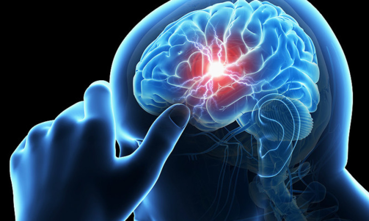 Εγκεφαλικό: Προσοχή στα πρώιμα σημάδια – Πώς να τα αναγνωρίσετε