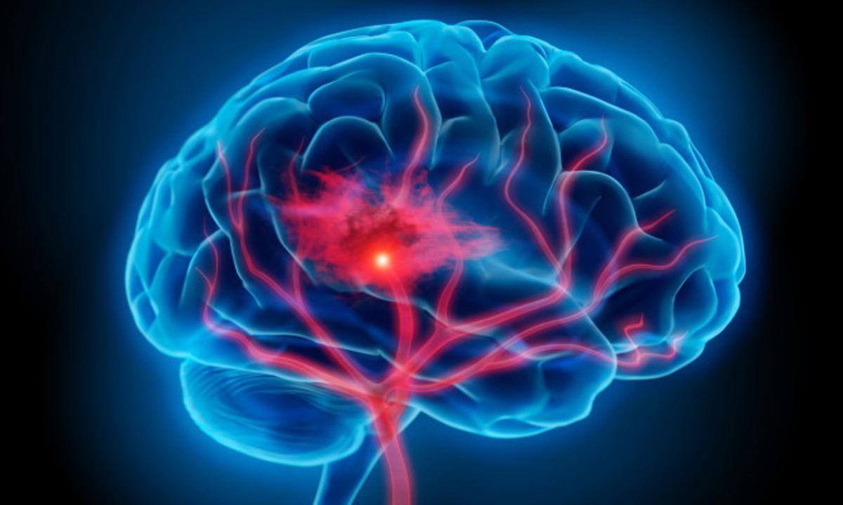 Εγκεφαλικό: Προσοχή στα συμπτώματα – Πώς μπορείτε να το προλάβετε