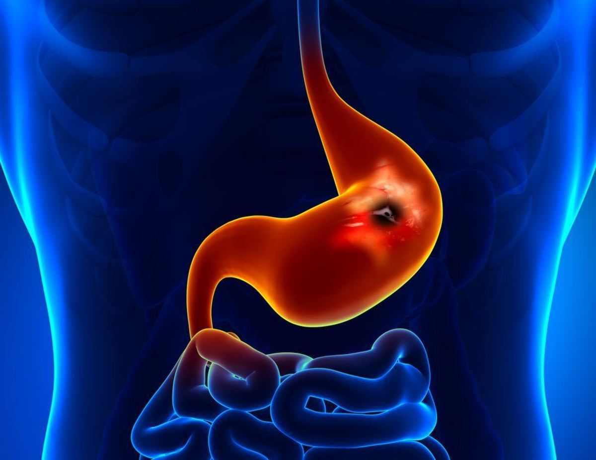 Έλκος στομάχου: Τι είναι ακριβώς, από τι προκαλείται και πώς αντιμετωπίζεται [vid]