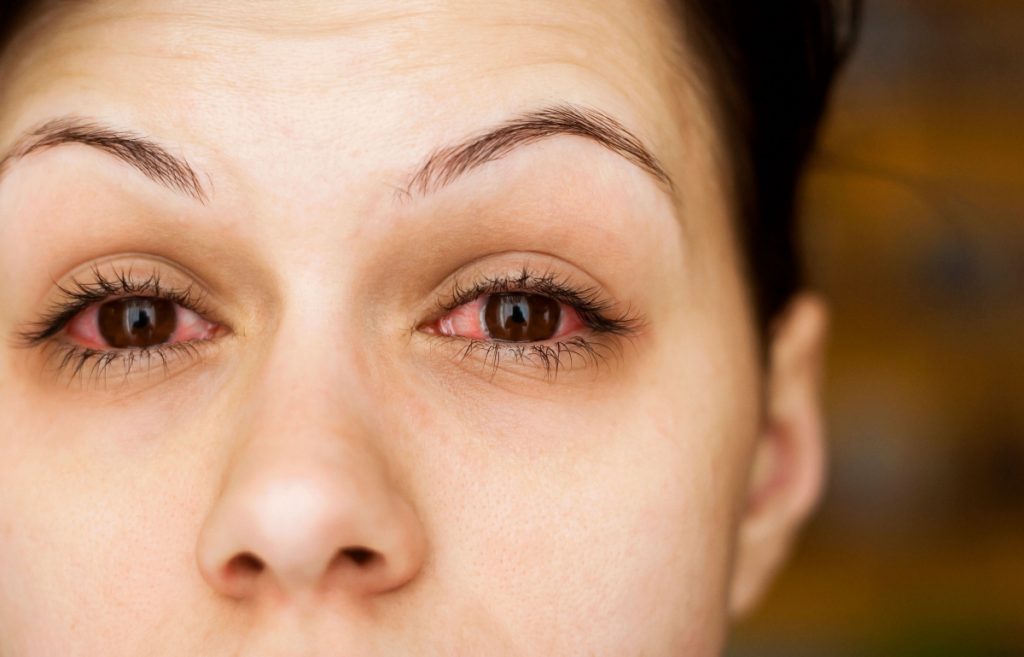 Αλλεργία στα μάτια: Αντιμετώπιση για φαγούρα, κοκκίνισμα και δάκρυα [vid]
