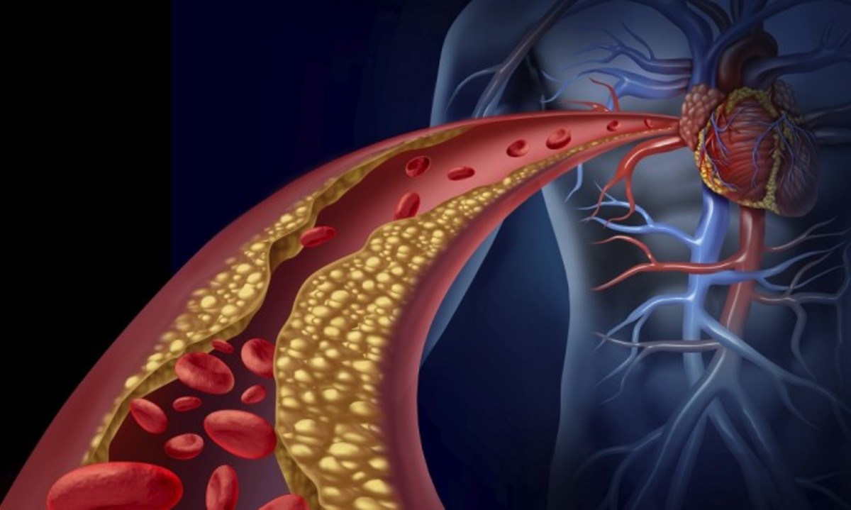 Αθηροσκλήρωση: Τι γίνεται στις αρτηρίες και προκαλείται έμφραγμα [vid]