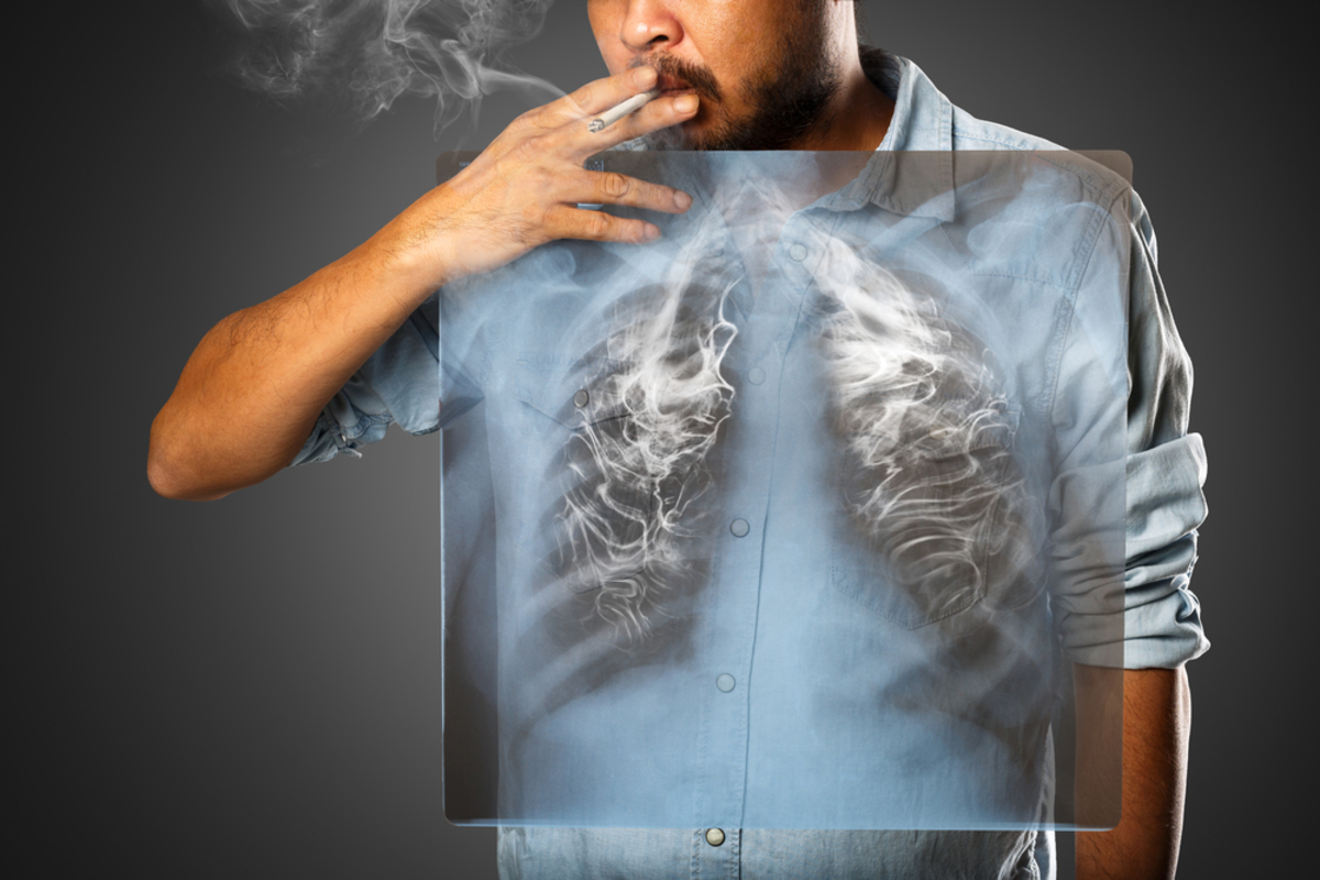 Κάπνισμα: Τα πάνω-κάτω φέρνει έρευνα για τα light τσιγάρα – Οδηγούν σε αδενοκαρκίνωμα;