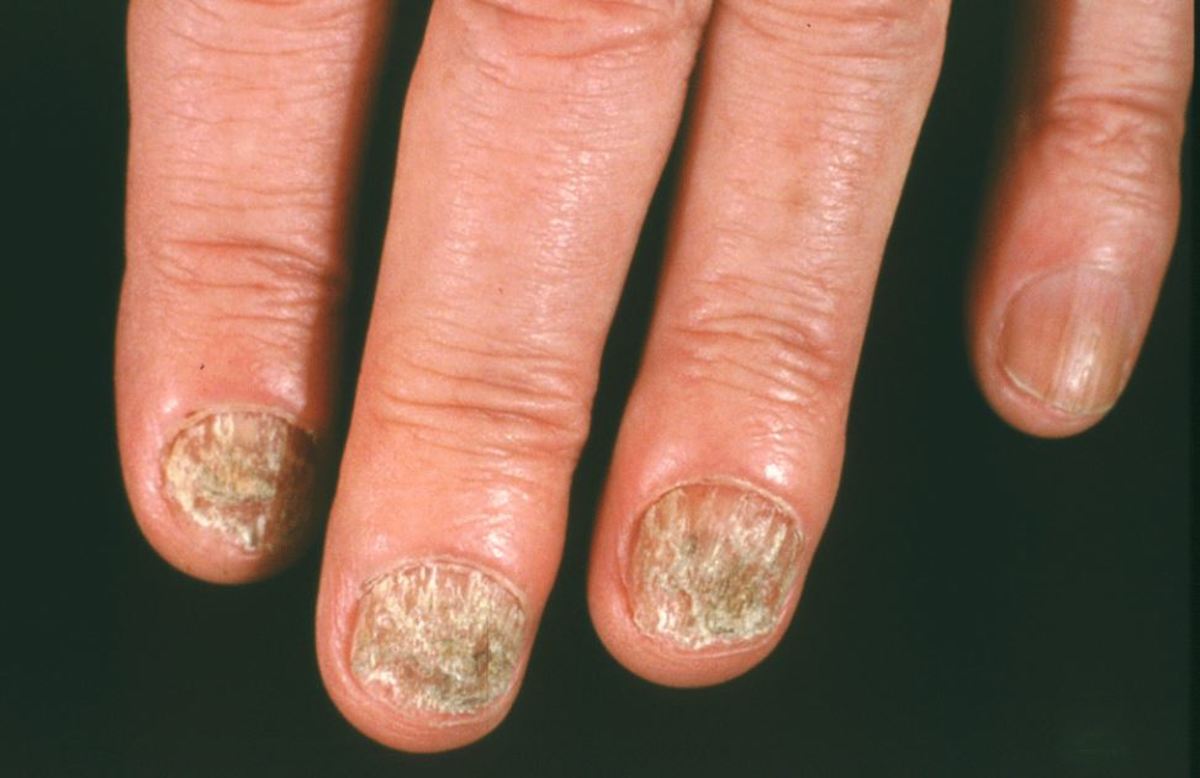 Μύκητες στα νύχια χεριών και ποδιών: Οι 8 κανόνες πρόληψης