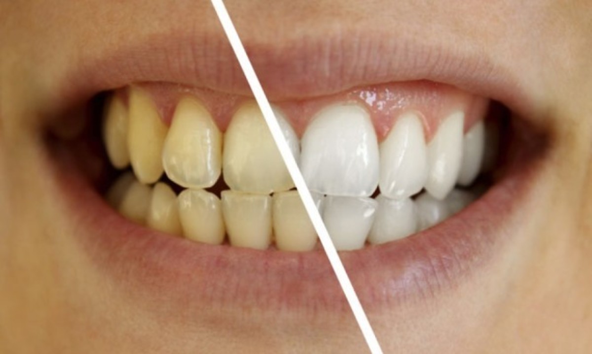 Το “μαγικό” διάλυμα για πιο αστραφτερά δόντια με το βούρτσισμα