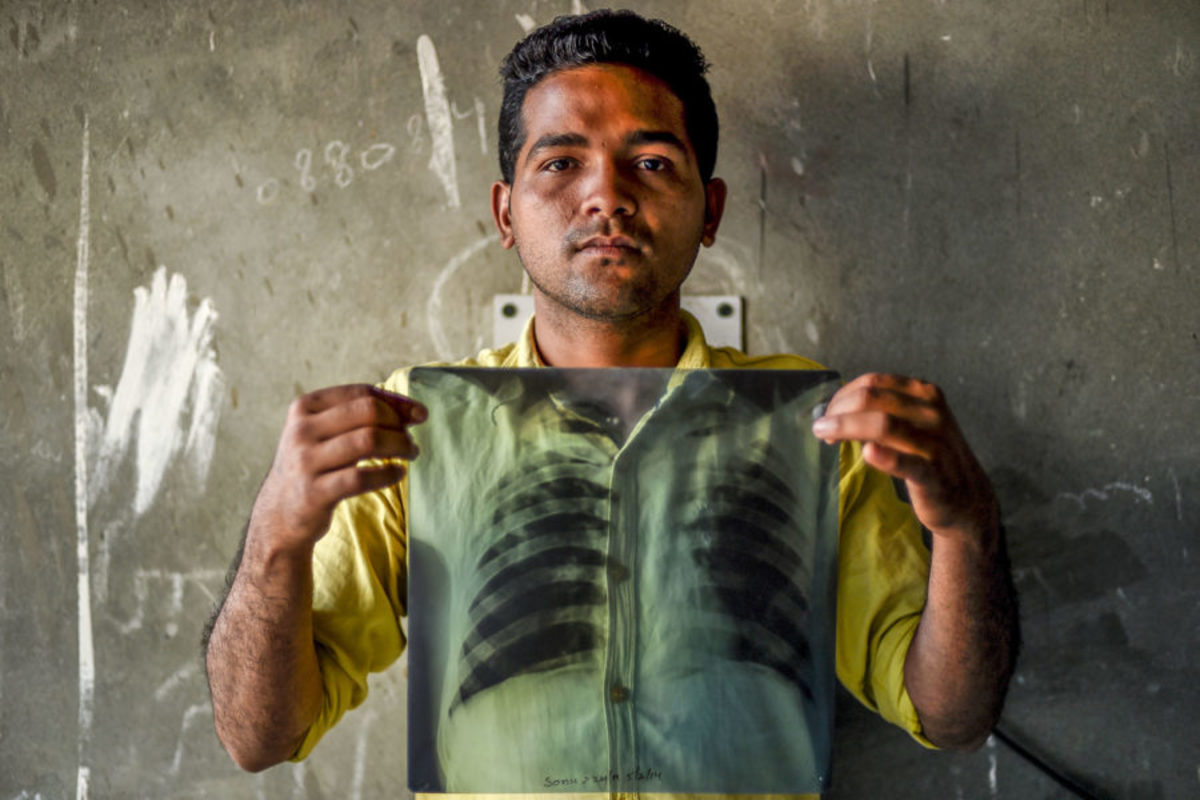 Παγκόσμια Ημέρα Φυματίωσης: Μήνυμα εγρήγορσης από τον ΠΟΥ – Τα συμπτώματα της ασθένειας