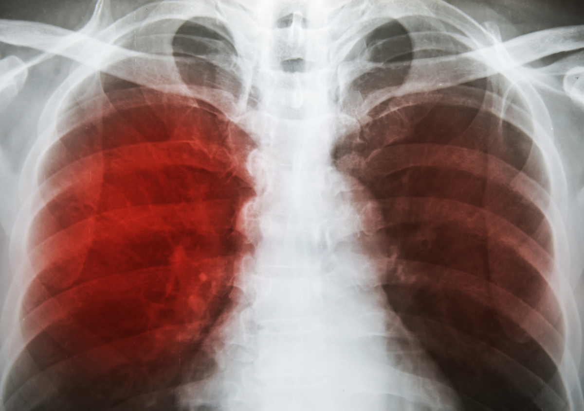 Φυματίωση: Διάγνωση με σύστημα Τεχνητής Νοημοσύνης!