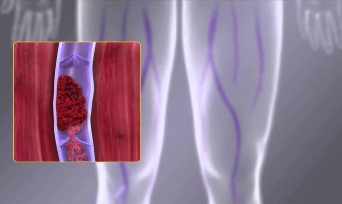 Φλεβική θρόμβωση: Ποιοι κινδυνεύουν από τον «σιωπηλό δολοφόνο»