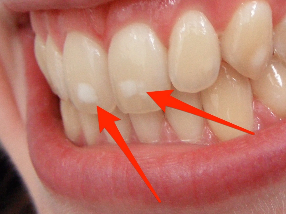 Πού οφείλονται ΑΥΤΑ τα λευκά σημάδια στα δόντια – Τι πρέπει να κάνετε
