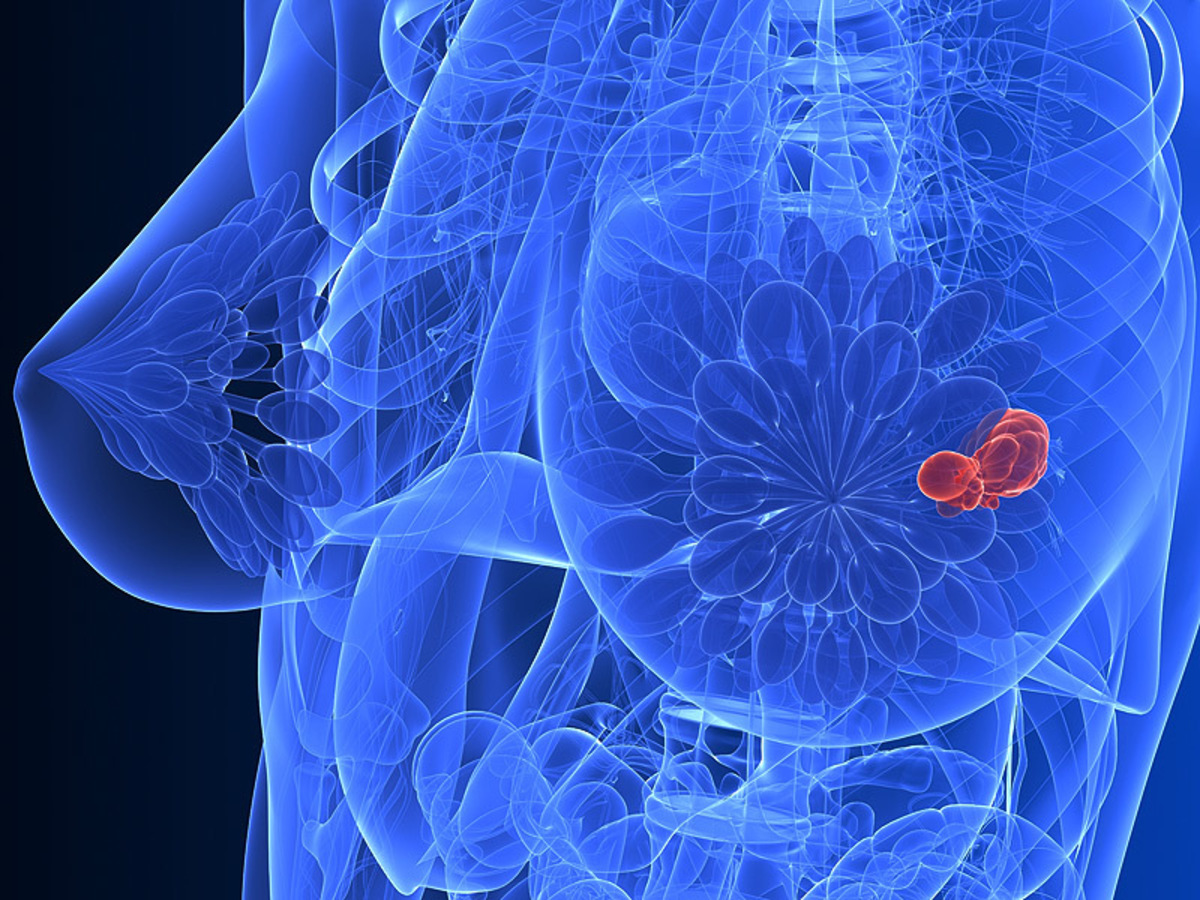 Καρκίνος του μαστού: Διπλάσιος ο κίνδυνος για τις γυναίκες με πυκνό μαστό