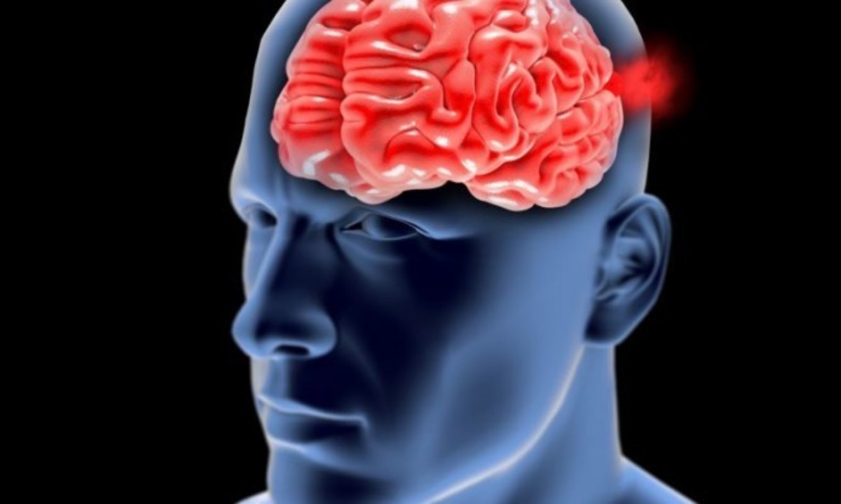 Ανεύρυσμα στον εγκέφαλο: Τα πρώιμα συμπτώματα που ΠΡΕΠΕΙ να ξέρετε
