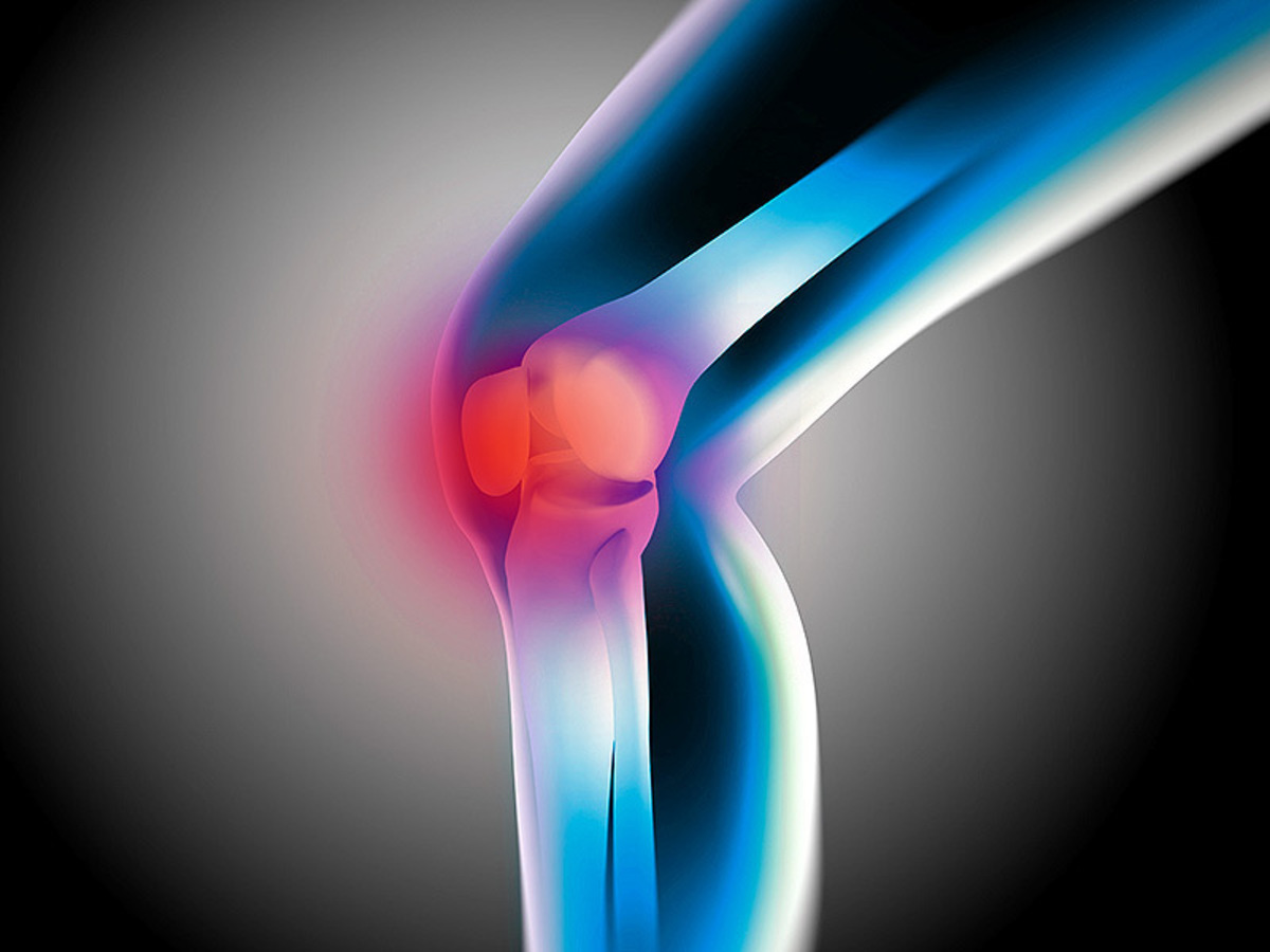 Οστεοαρθρίτιδα: Διάγνωση με εξέταση αίματος πολύ πριν εκδηλωθεί