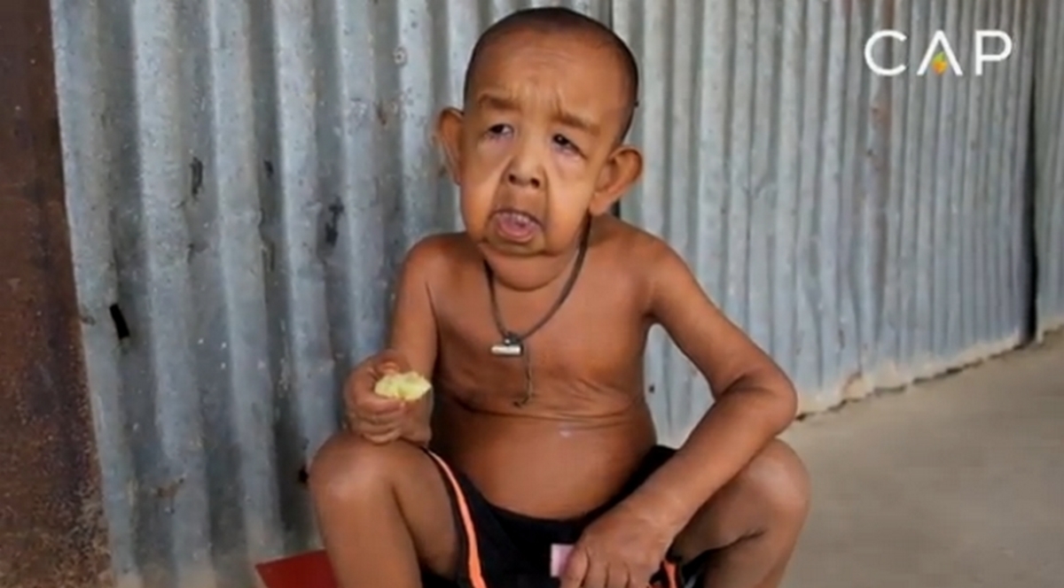 Η συγκλονιστική ιστορία του 4χρονου που μοιάζει 80χρονος [vid]