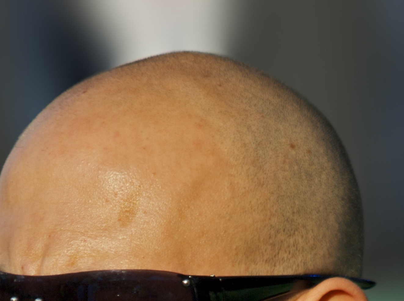 Ανακαλύφθηκε χημική ουσία που φυτρώνει μαλλιά!