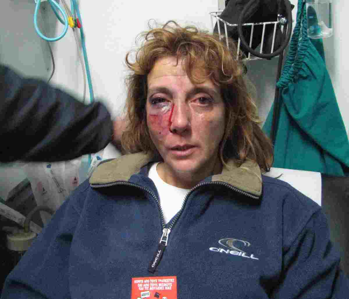 Διαδηλώτρια: Έβλεπα το γκλομπ να πέφτει στο πρόσωπό μου!