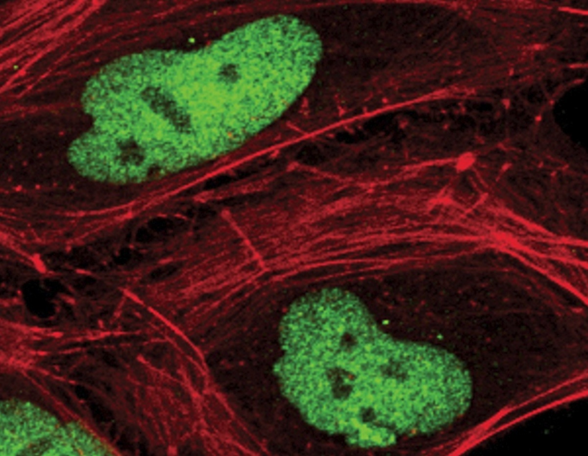 Γονίδιο δείχνει τον κίνδυνο εμφάνισης καρκίνου του στήθους