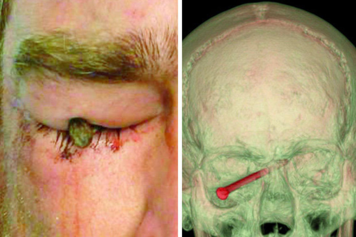 Του μπήκε καρφί στο μάτι! ΠΡΟΣΟΧΗ, ΣΚΛΗΡΕΣ ΕΙΚΟΝΕΣ