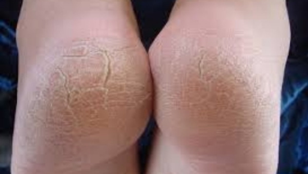 Τι μπορείτε να κάνετε για τις “σκασμένες” φτέρνες στα πόδια