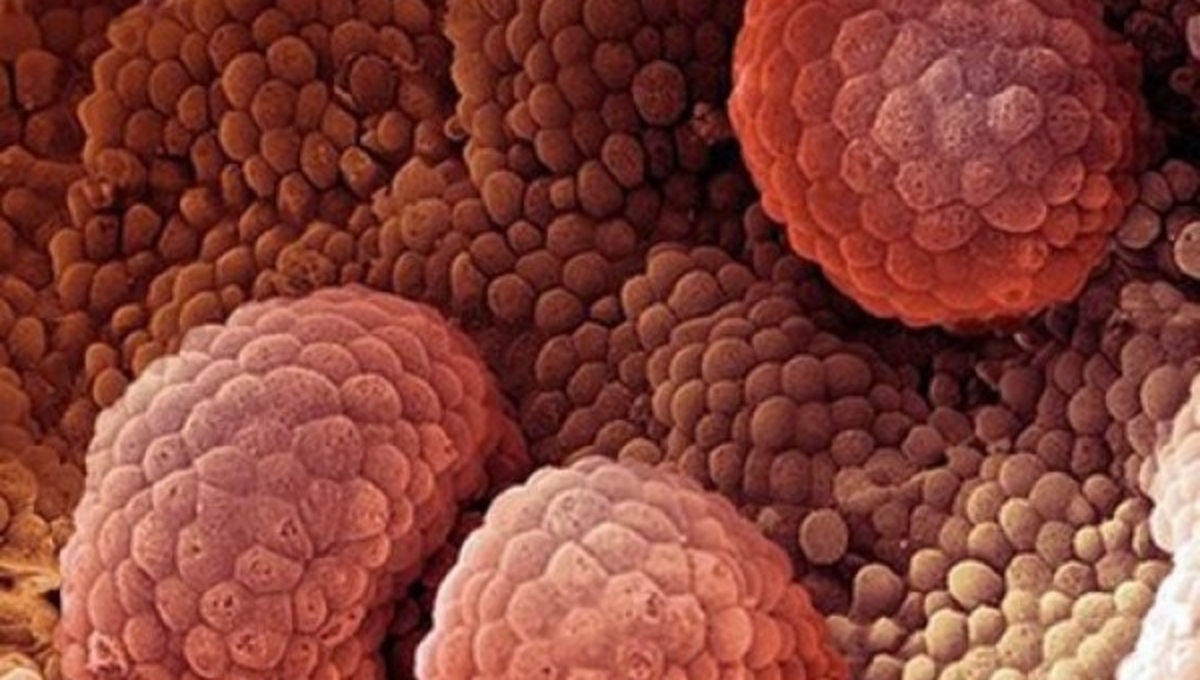 Καρκίνος προστάτη: Εντοπίστηκαν 5 διαφορετικά είδη