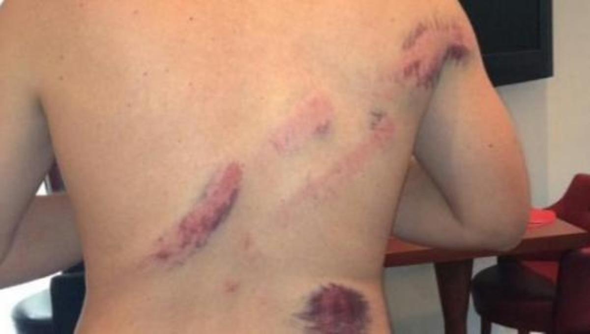 “Μαυρισμένος” απ΄το ξύλο οπαδός της Μονπελιέ καταγγέλει την ελλ.αστυνομία