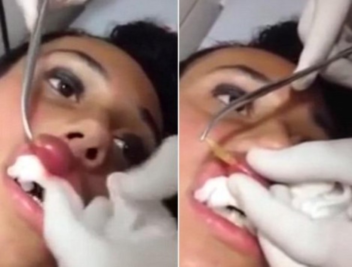 Αφαίρεσαν σκουλήκι από κοπέλα