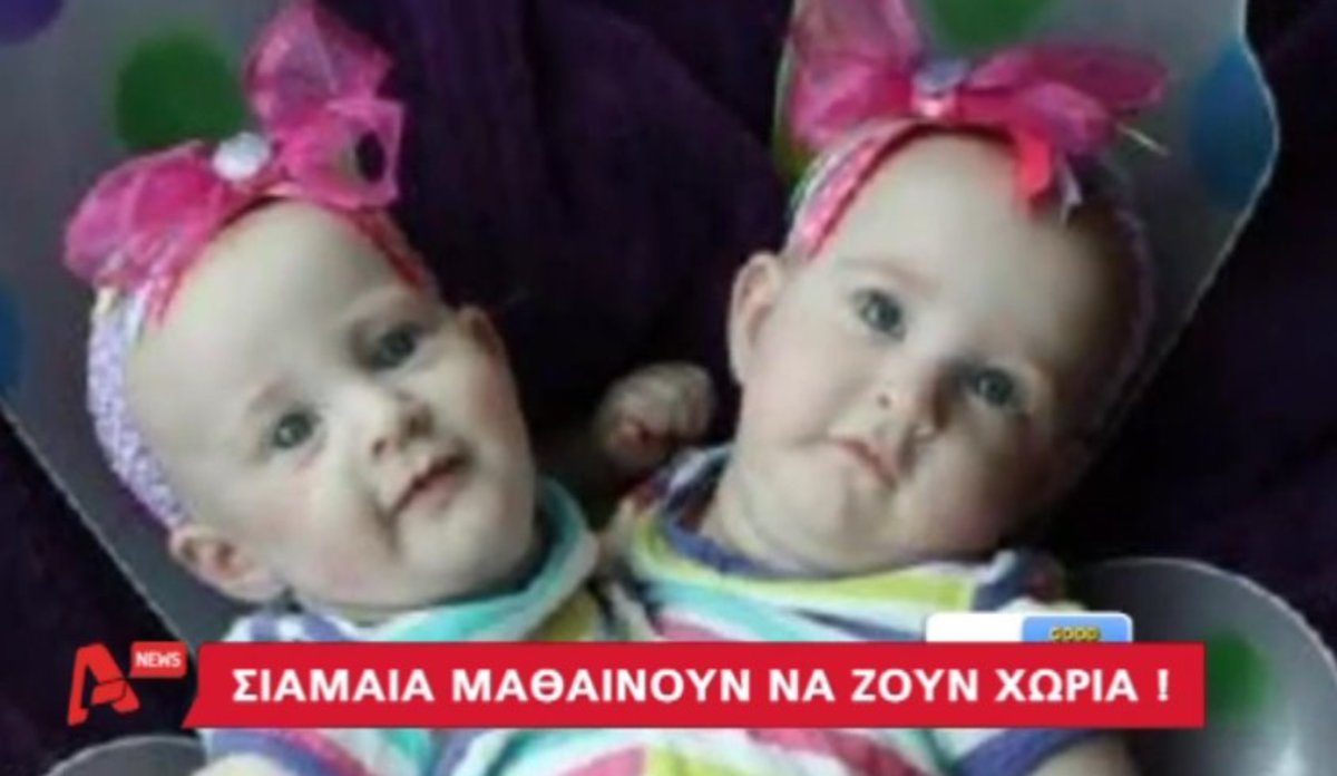 Σιαμαία κοριτσάκια που διαχωρίστηκαν