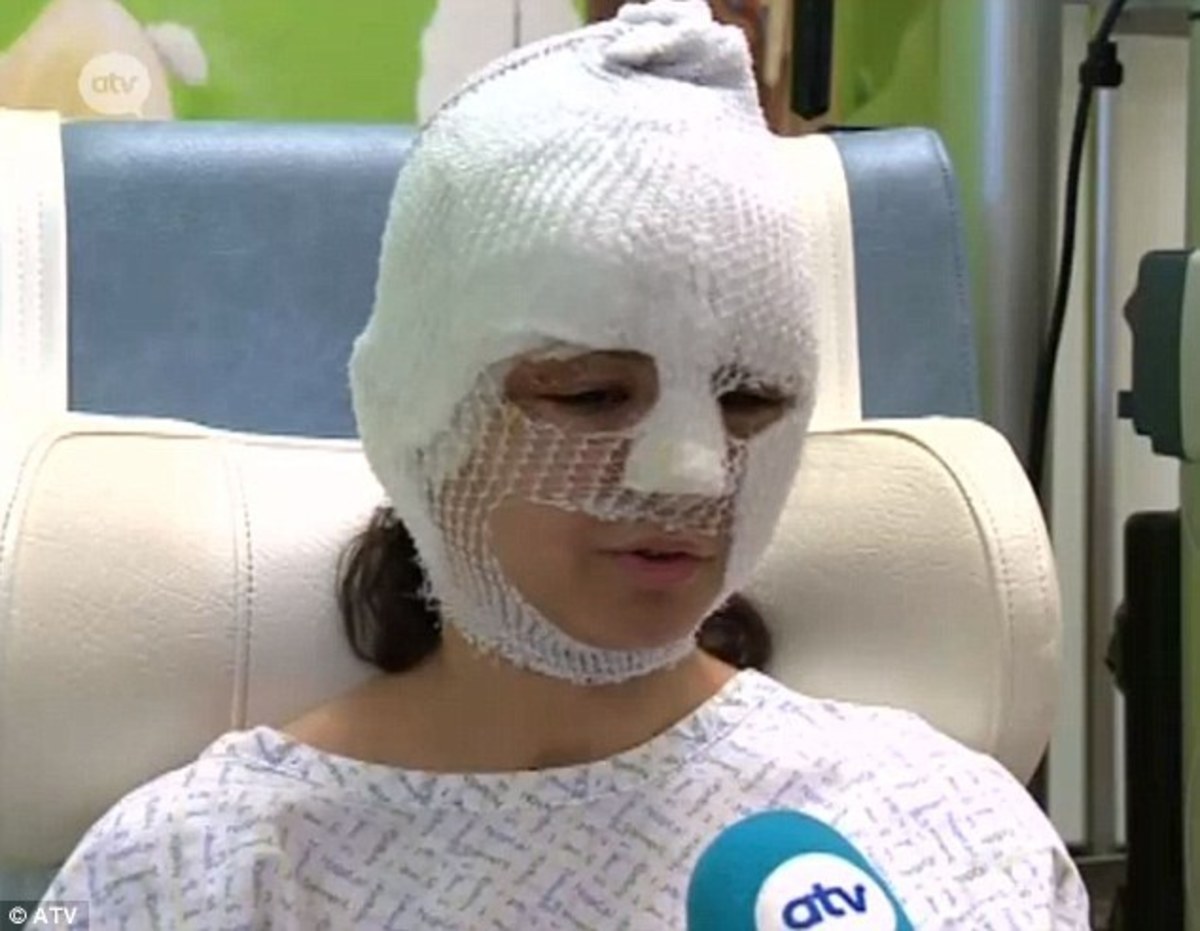 “Έμοιαζε με το τέλος του κόσμου” – Η μαρτυρία 20χρονης που κάηκε το μισό της πρόσωπο στις Βρυξέλλες