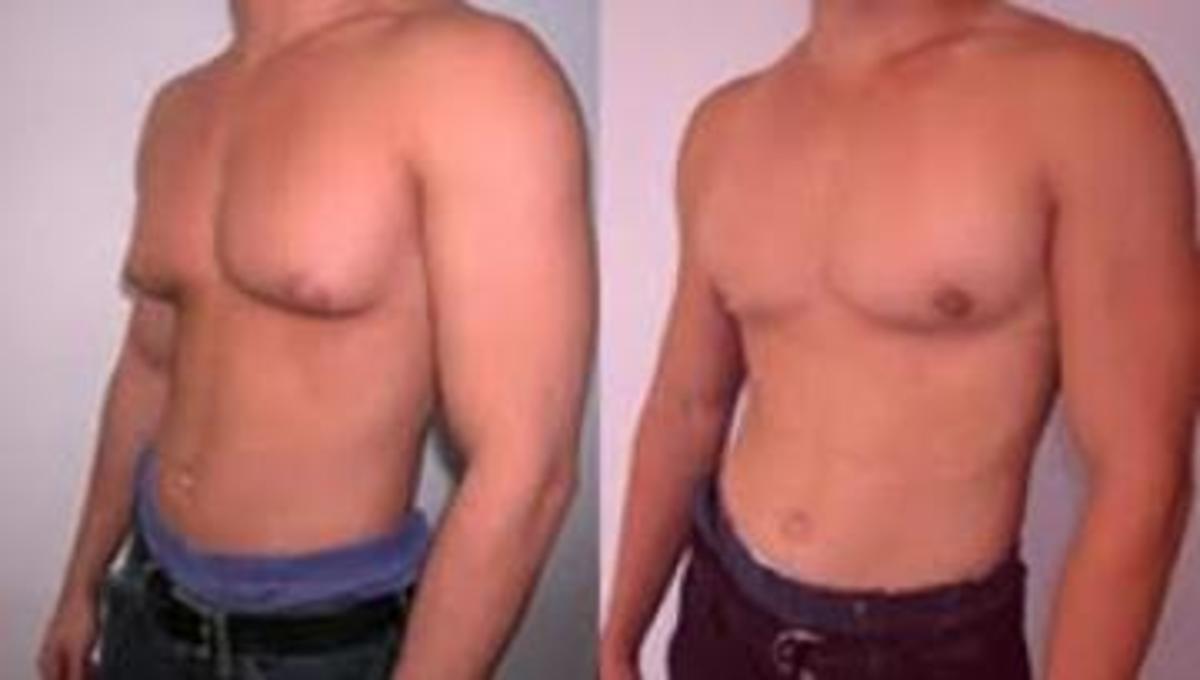 Τεράστια αύξηση στις επεμβάσεις σμίκρυνσης του ανδρικού στήθους